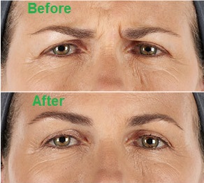 xeomin before after cheri