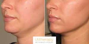 Ultherapy2
