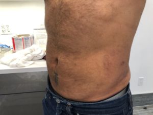Male Liposuction AFTER